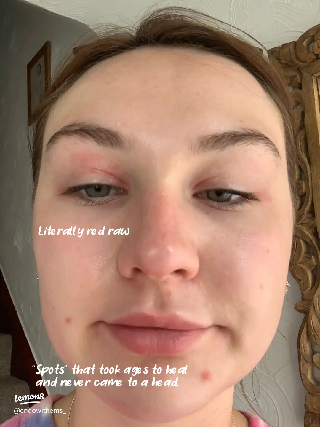 Symptoms of Autoimmune disease's images(4)