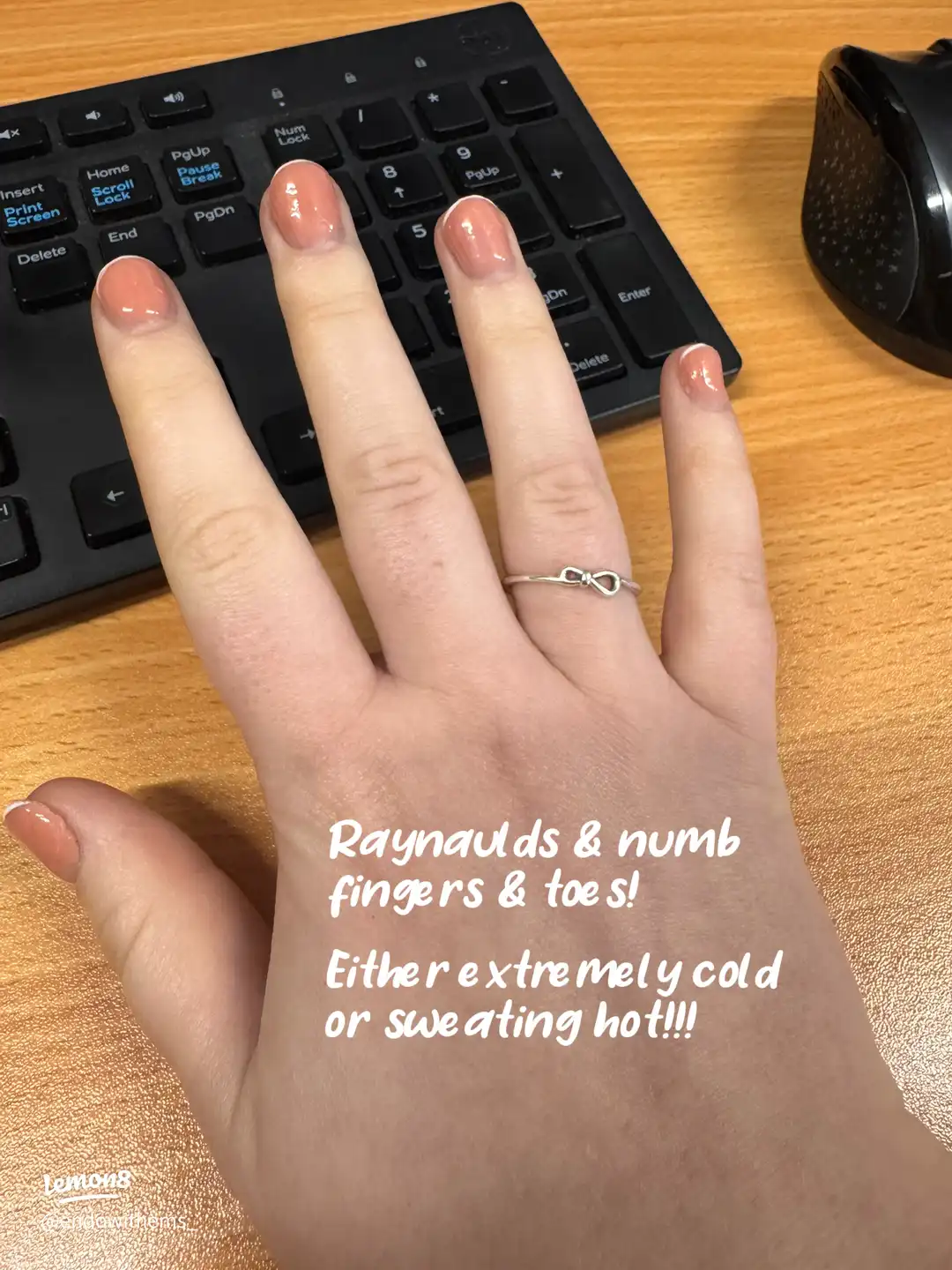 Symptoms of Autoimmune disease's images(5)