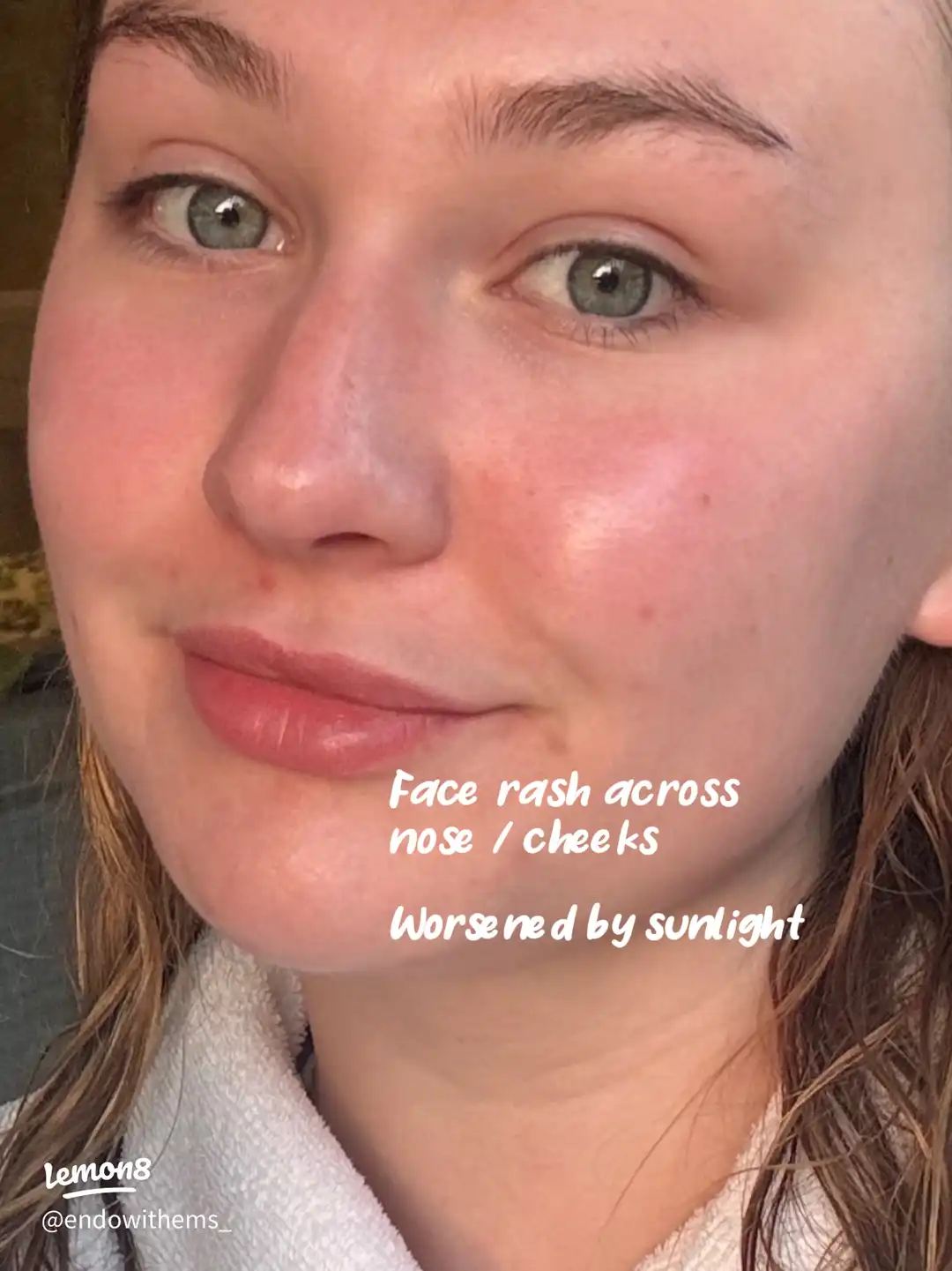 Symptoms of Autoimmune disease's images(3)